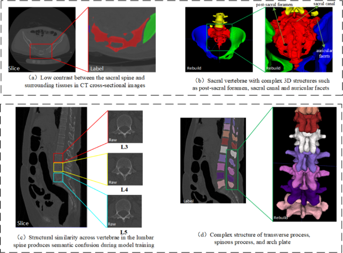 Lumbar and pelvic CT image segmentation based on cross-scale feature fusion and linear self-attention mechanism