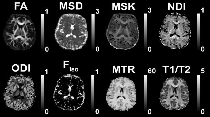 Complementary MR measures of white matter and their relation to cardiovascular health and cognition