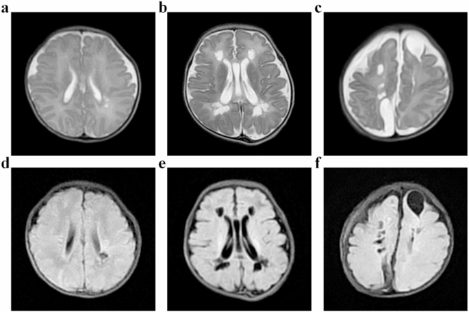 The effect of hemoglobin level in early life on periventricular leukomalacia: a case control study