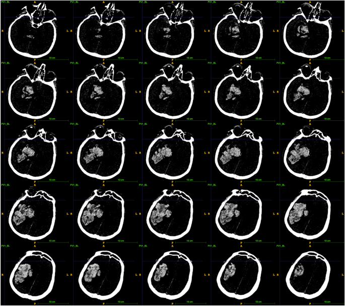Adapting foundation models for rapid clinical response: intracerebral hemorrhage segmentation in emergency settings