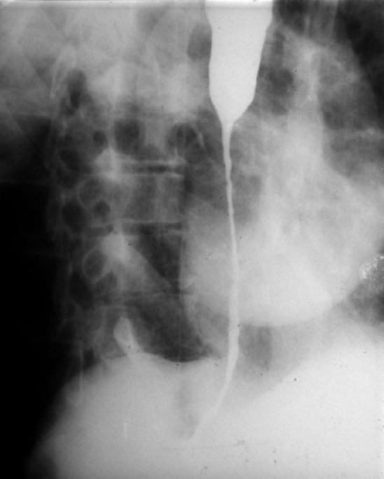 Successes and failures of using the intestine as a pedicled oesophageal substitute of corrosive burns