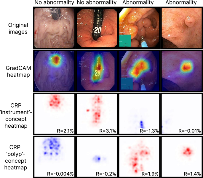 Exploring the clinical value of concept-based AI explanations in gastrointestinal disease detection
