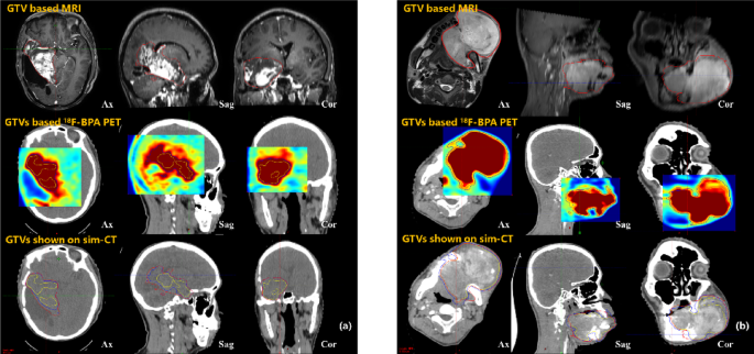 MRI and 18F-BPA PET-guided targeting in boron neutron capture therapy