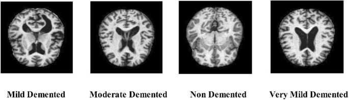 A novel interpreted deep network for Alzheimer’s disease prediction based on inverted self attention and vision transformer