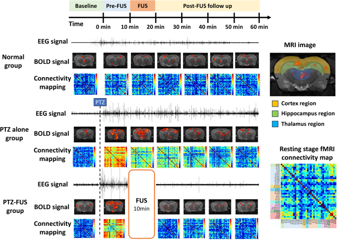 Focused ultrasound suppresses pentylenetetrazol-induced epileptiform activity in rats and alters connectivity measured by functional MRI