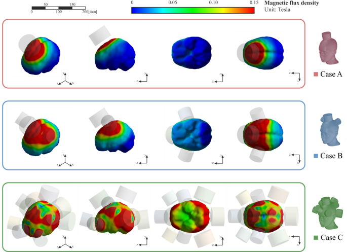 Numerical simulation of transcranial static magnetic fields for the treatment of global epilepsy in children