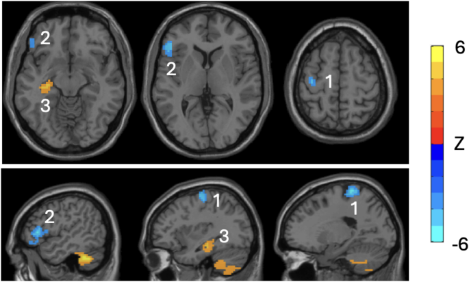 Regional hyperconnectivity in the medial temporal lobes as a maladaptive mechanism for colorectal cancer-related cognitive decline