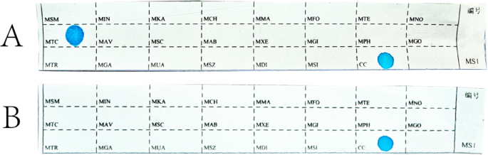 Higher proportion of coagulative necrosis and PD-L1+ immune cells in splenic tuberculosis