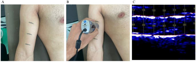 Muscle thickness from amplitude mode ultrasound and clinical outcomes in patients with cancer