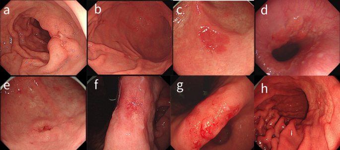 A nomogram for predicting non-curative resection in patients with early gastric cancer based on white light imaging