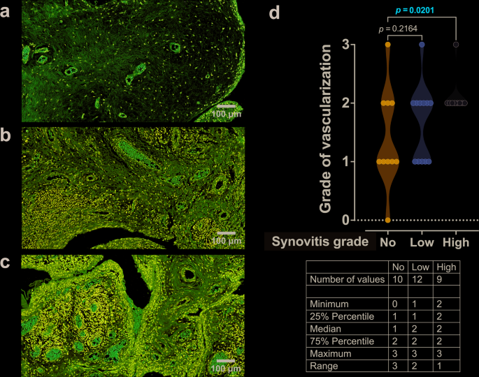 Distinct late-stage osteoarthritis profiles identified through NF-κB, TNF-α, and TGF-β–driven synovial inflammation and pain