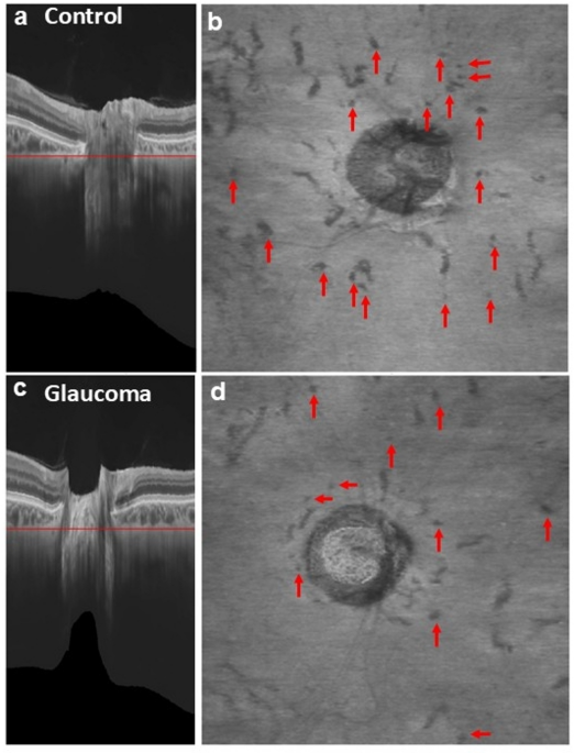 Comparison of the number of peripapillary perforating scleral vessels between glaucomatous eyes and healthy eyes