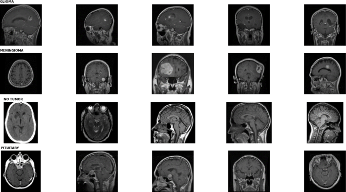 A novel residual network based on multidimensional attention and pinwheel convolution for brain tumor classification