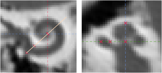 Accuracy assessment of a cochlear implant imaging tool using clinical computed tomography images