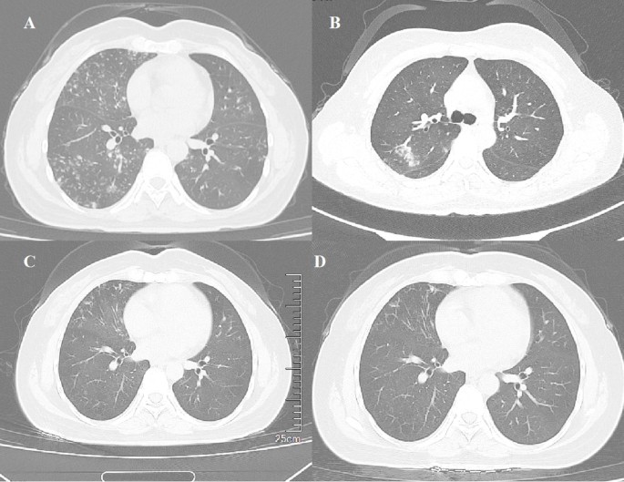 Mycobacterium hainanense sp. nov. represents an emerging nontuberculous Mycobacterium associated with chronic pulmonary disease