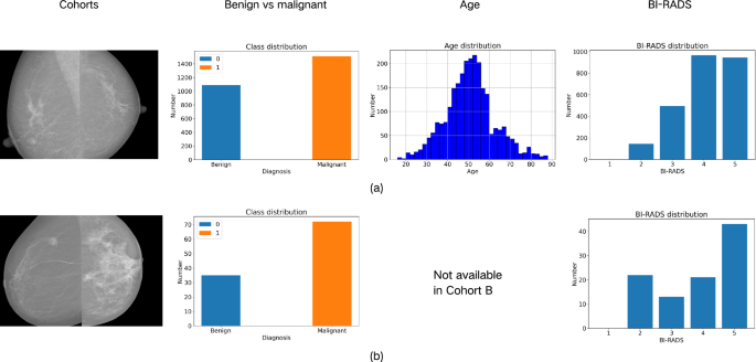 Quantum integration in swin transformer mitigates overfitting in breast cancer screening