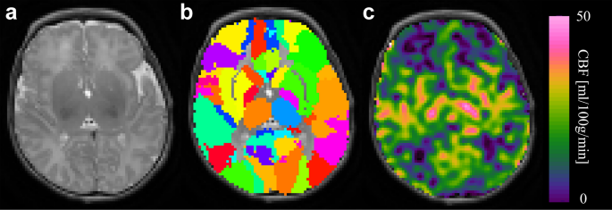 ASL reveals regional brain perfusion impairment in neonates with mild hypoxic ischemic encephalopathy