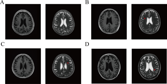 Myelin basic protein and occludin may be the biomarkers to diagnose leukoaraiosis and cognitive dysfunction