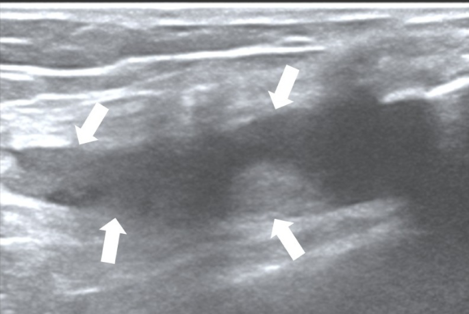 Comparing thermographic heat signatures with joint inflammation detected by ultrasound at the knees in patients with rheumatoid arthritis