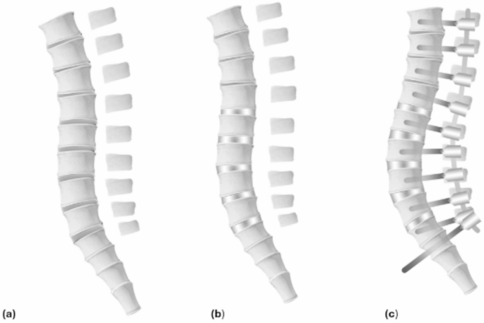 Predicting postoperative imbalance in adult spinal deformity staged surgery using predictive thresholds