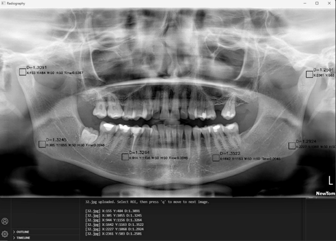 Automated fractal analysis for mandibular bone evaluation in type 1 diabetes mellitus using a novel single click approach