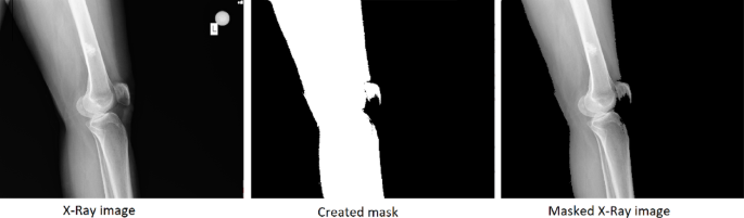 A comprehensive deep learning approach to improve enchondroma detection on X-ray images