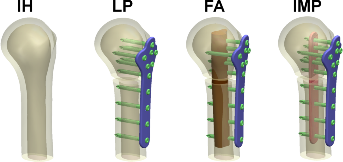 Biomechanics of humeral locking plate augmented with fibular strut allograft and intramedullary strut plate using finite element analysis
