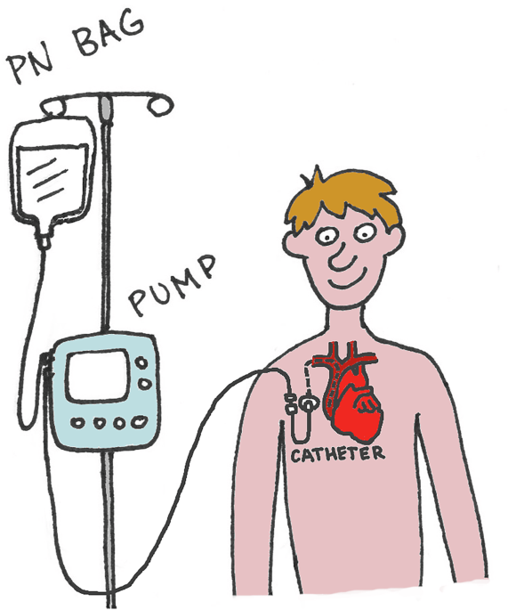 Inflammable object lessons: sustaining “life without a gut” on home parenteral nutrition