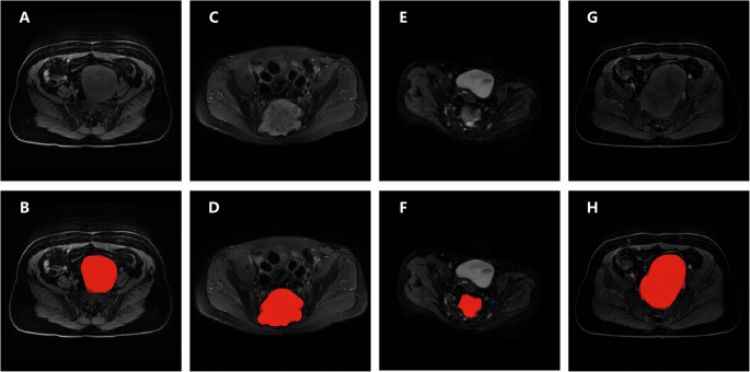 End-to-end deep learning for the diagnosis of pelvic and sacral tumors using non-enhanced MRI: a multi-center study