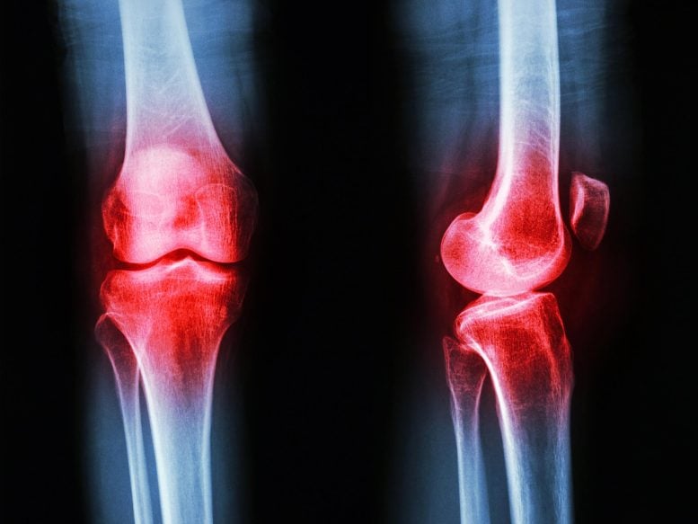 Scientists Discover Simple Way To Relieve Arthritis Pain