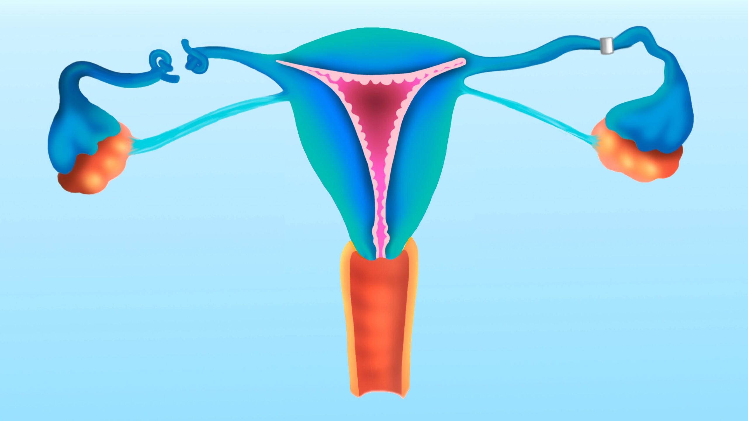 How does ‘getting your tubes tied’ work?