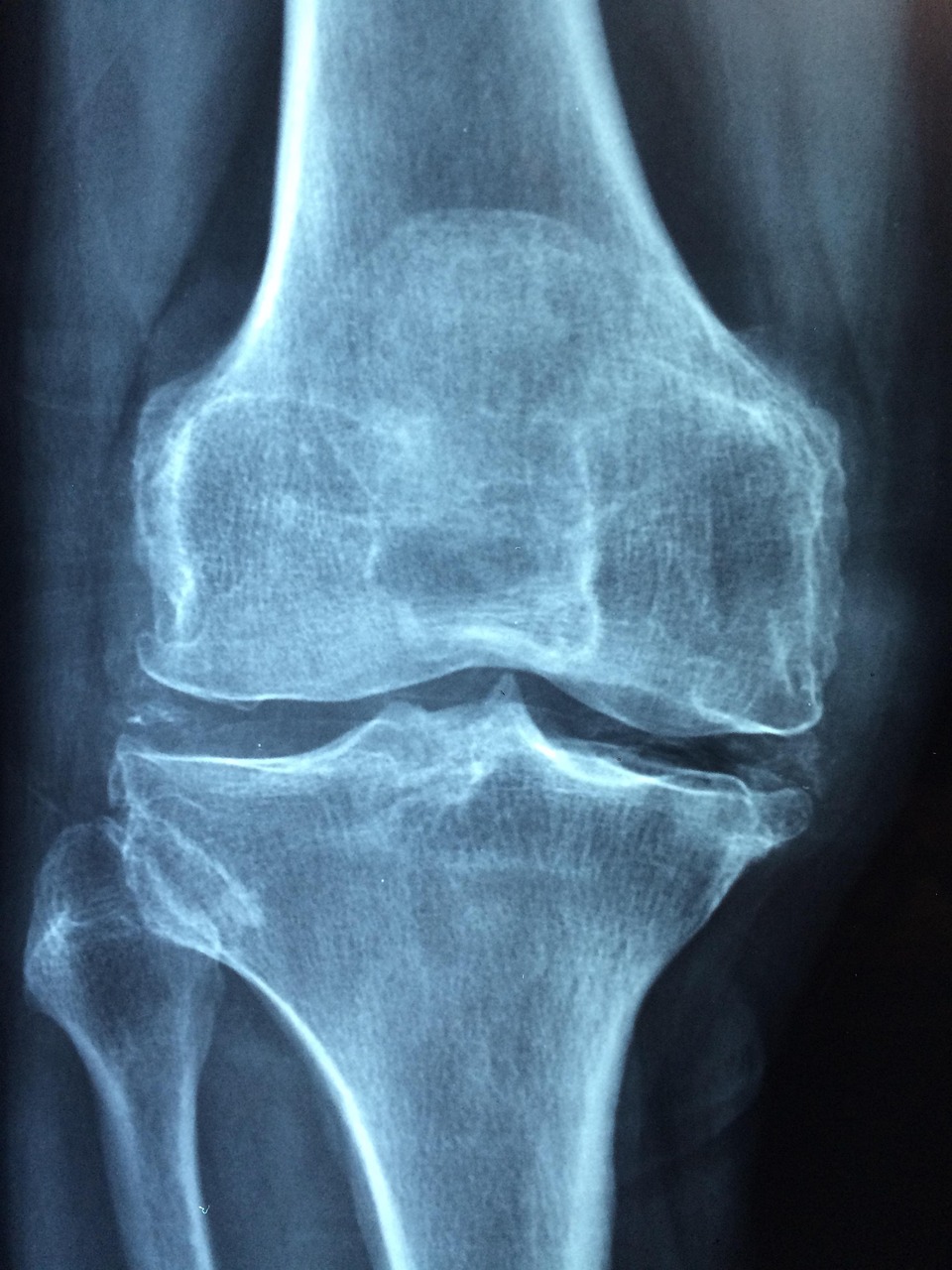 Collection of Immune Cells Drive Rheumatoid Arthritis Progression