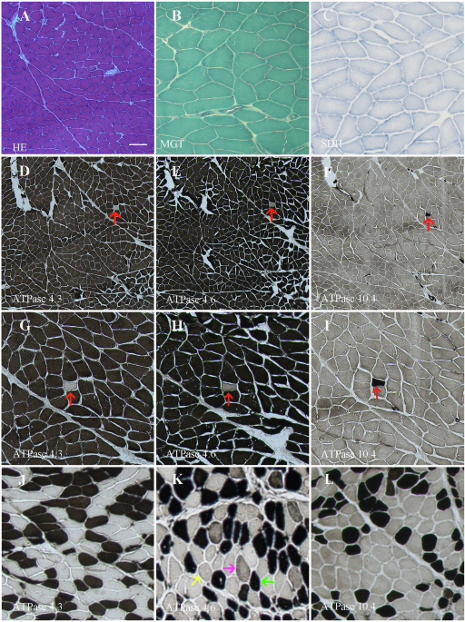 MYH2-associated myopathy caused by novel compound heterozygous mutations: a case report and literature review