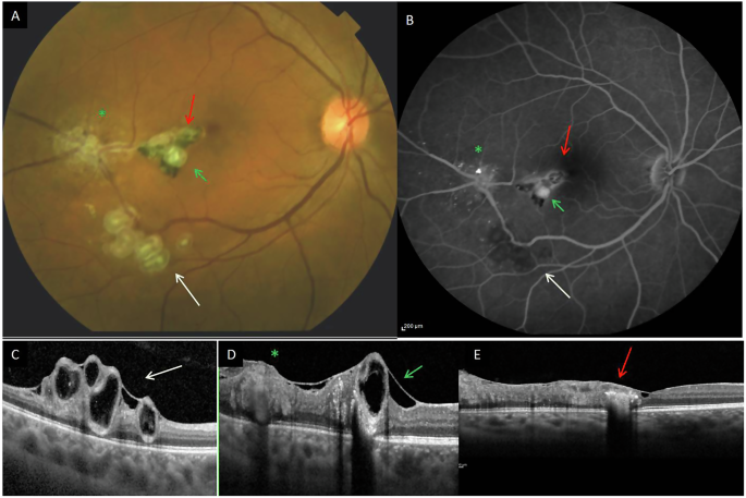 Hyalinised pearls: atypical retinal cavernous haemangioma