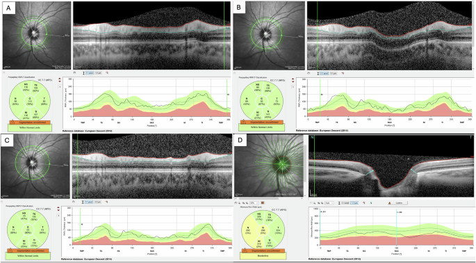 Evaluation of optic nerve head morphology of small optic discs in healthy eyes with different optical coherence tomography parameters