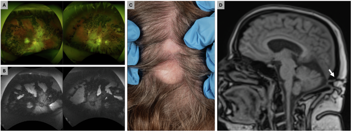 Beware the midline scalp lump in a patient with retinal dystrophy