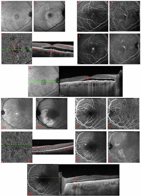 Flat irregular pigment epithelium detachments in chronic central serous chorioretinopathy: a focus on choroidal changes