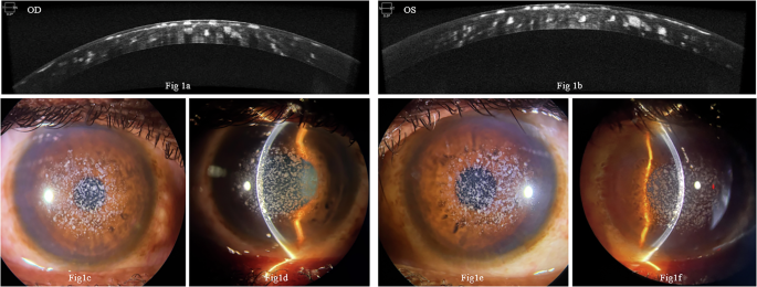 Starry sky appearance of type 1 granular corneal dystrophy