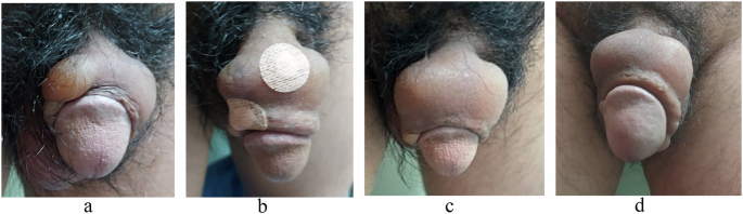 Managing residual volumes in penile girth enhancement with hyaluronic acid fillers: a case series and literature review