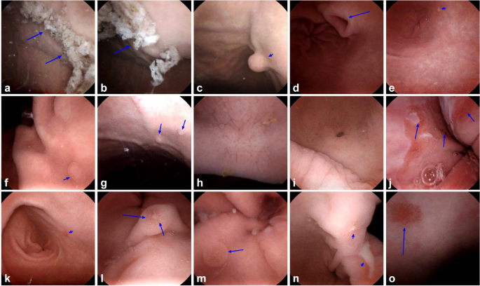 Diagnostic value of magnetic controlled capsule endoscopy in patients with chronic abdominal pain: a retrospective two-center study