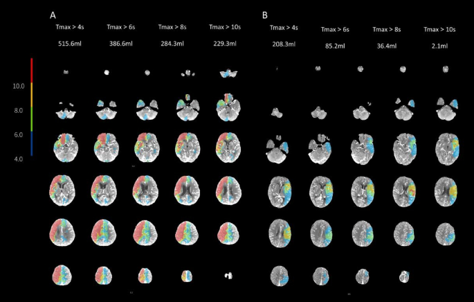 The hypoperfusion intensity ratio associates with APOE gene polymorphism in acute ischemic stroke patients with large vessel occlusion