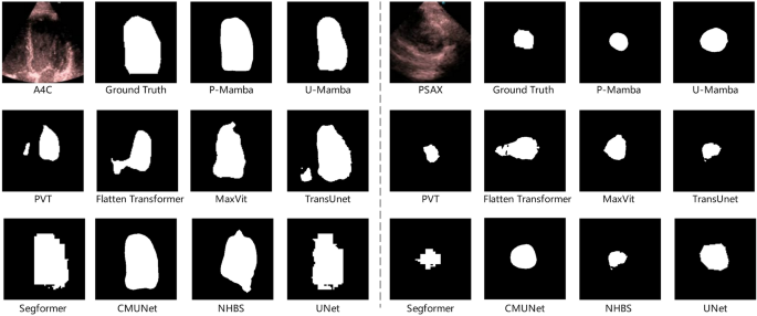 Marrying Perona Malik diffusion with Mamba for efficient pediatric echocardiographic left ventricular segmentation