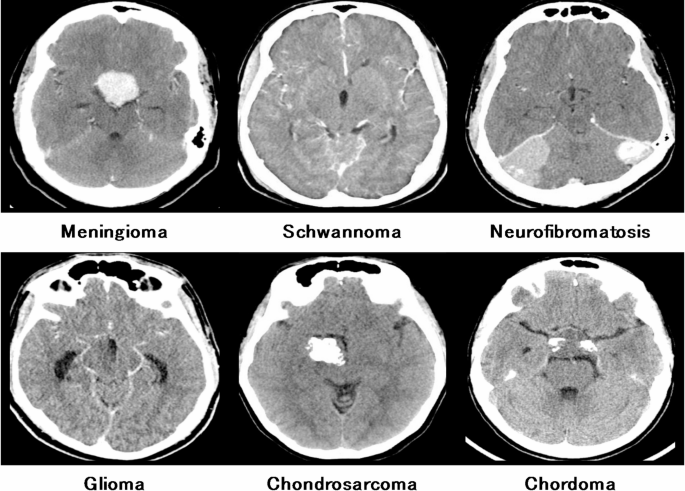 Computer vision based efficient segmentation and classification of multi brain tumor using computed tomography images