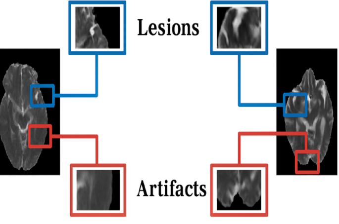Automated deep U-Net model for ischemic stroke lesion segmentation in the sub-acute phase
