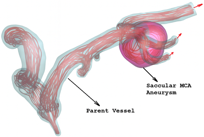 Use of proper orthogonal decomposition and machine learning for efficient blood flow prediction in cerebral saccular aneurysms