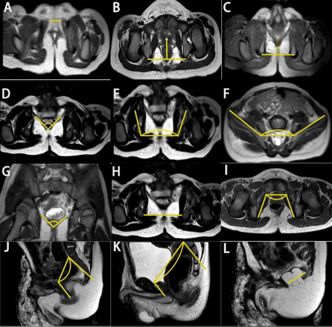 Impact of pelvic floor anatomical variations on urinary continence outcome in boys with epispadias