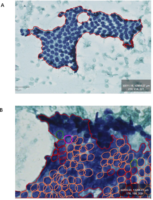 Interpretable AI-assisted diagnosis of papillary thyroid cancer cytopathology using graph neural networks and knowledge graphs