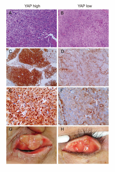 Nucleus YAP expression as a prognostic biomarker for local recurrence in eyelid sebaceous carcinoma
