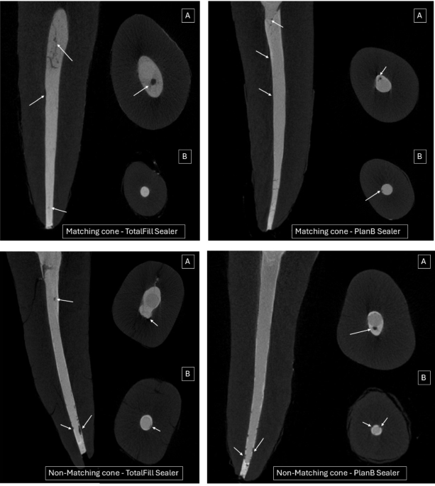 Impact of cone system compatibility on single cone bioceramic obturation in canals prepared with variable taper NiTi rotary files
