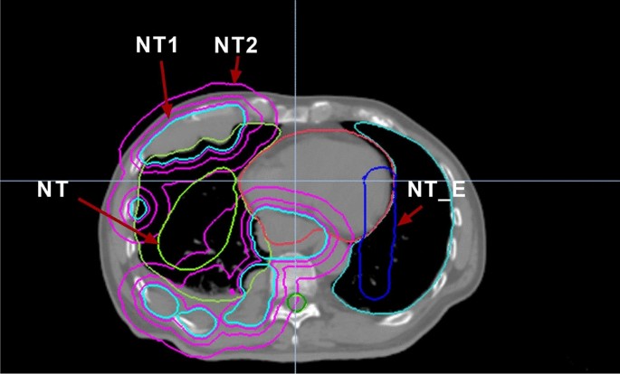 A case study on optimizing helical tomotherapy parameters for small cell lung cancer with extensive pleural metastasis